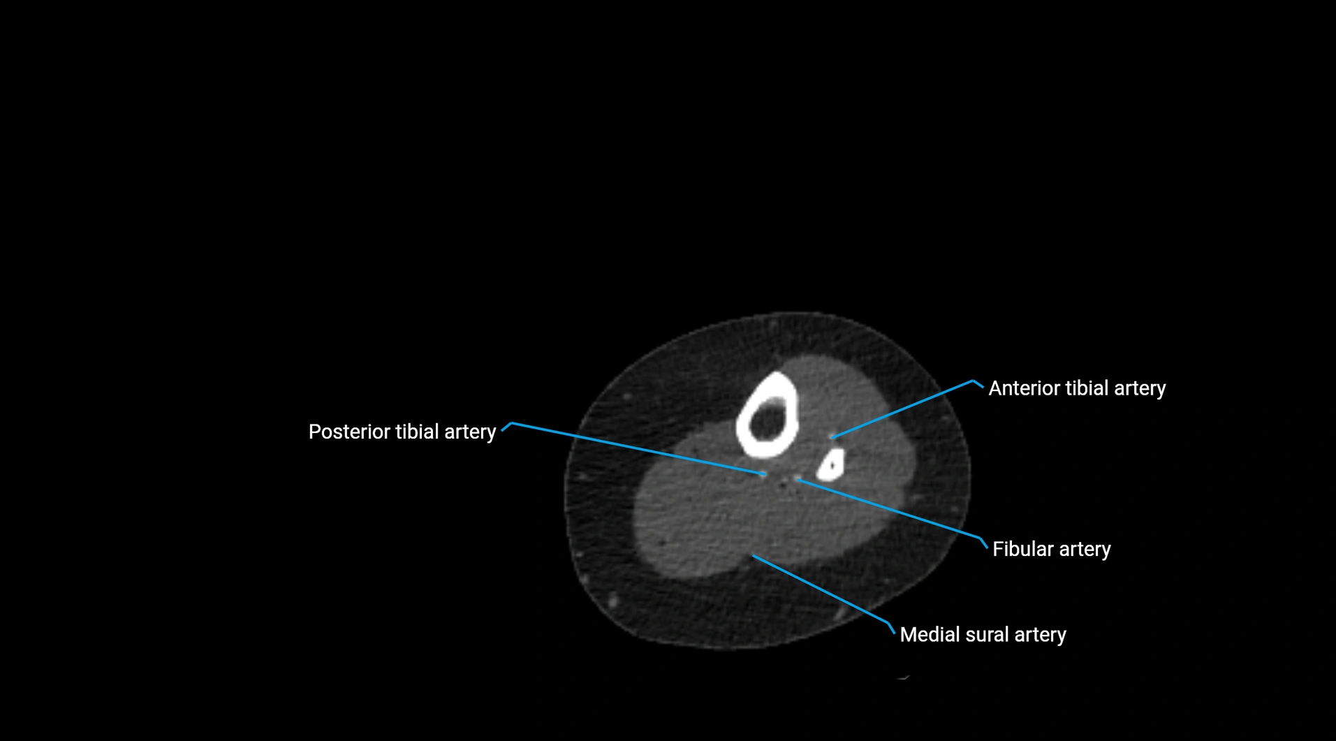 CTA lower limb cross sectional anatomy labelled image _208 - Copy.webp